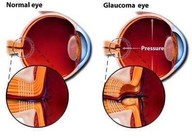 glaucoma medical illustration